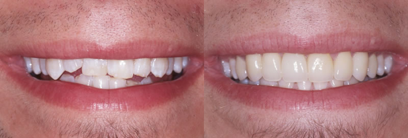 Porcelain Veneers Porcelain Veneers