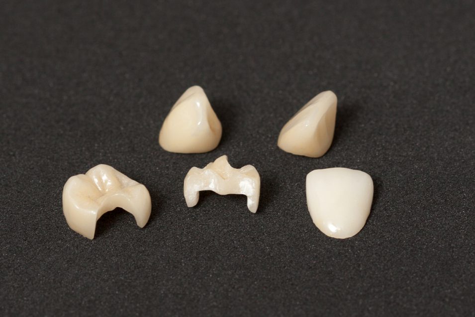 Crowns, inlays and veneers of leucite ceramics