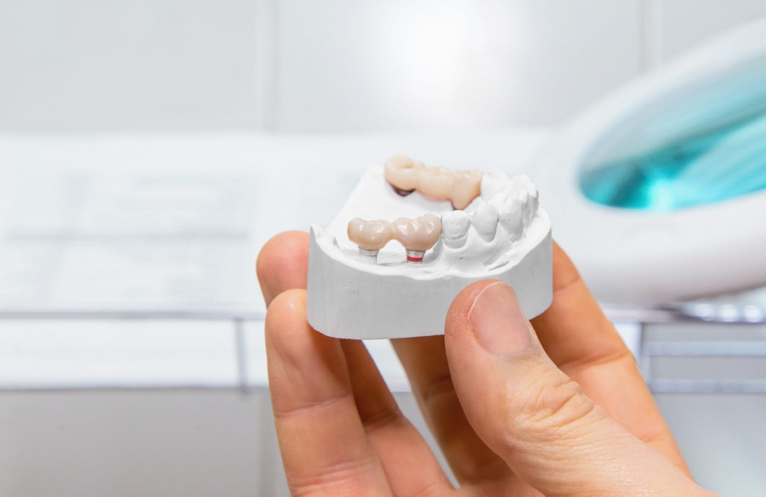 Dentist showing dental bridges model at nearby dental office