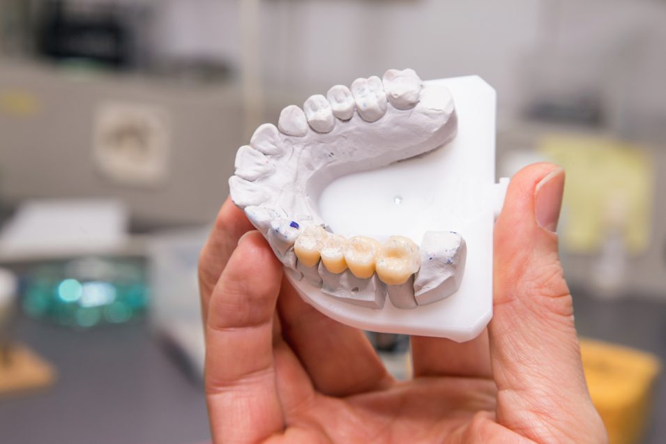 Dentist showing dental bridges model at dental office in North York