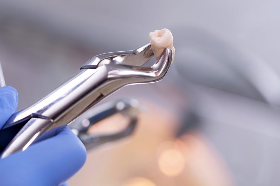 teeth extractions near you