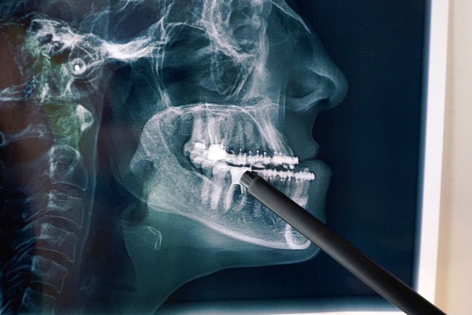 Nearby dentist suggesting Oral and Maxillofacial Surgery for patient showing his x-ray