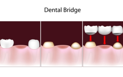 How Many Teeth Can You Realistically Replace Using a Dental Bridge?