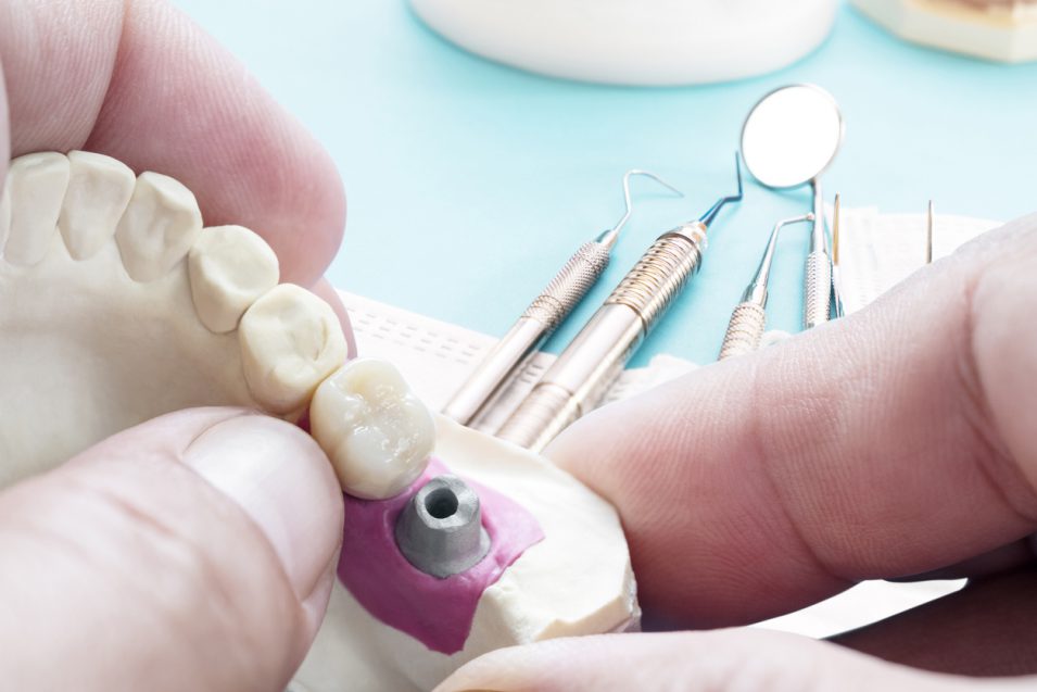 Dentist showing prosthodontics model in North York